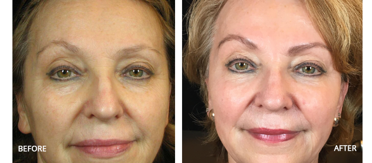 CO2 Laser Resurfacing - Rejuva Medispa & Laser